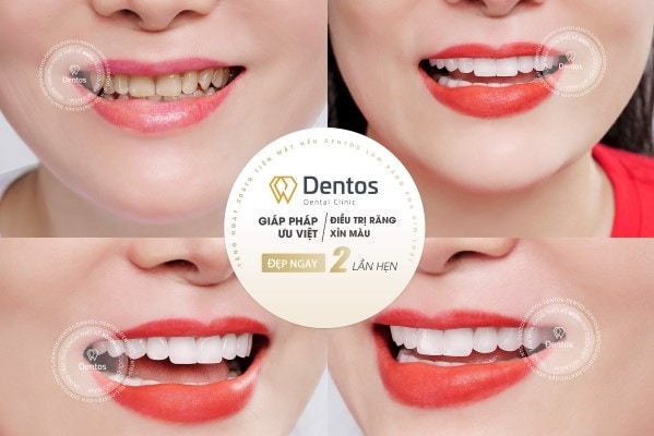 Kỹ thuật bọc răng sứ thông thường diễn ra trong khoảng 2 buổi.